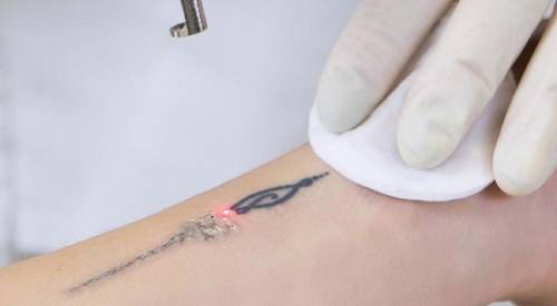 tattoo removal in anna nagar