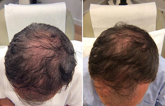 prp for hair loss clinic in anna nagar