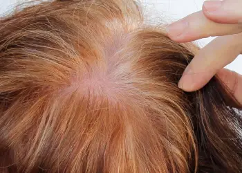 prp for hair loss clinic in anna nagar