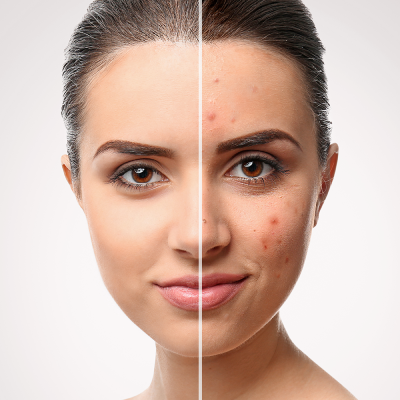 acne clinic in anna nagar