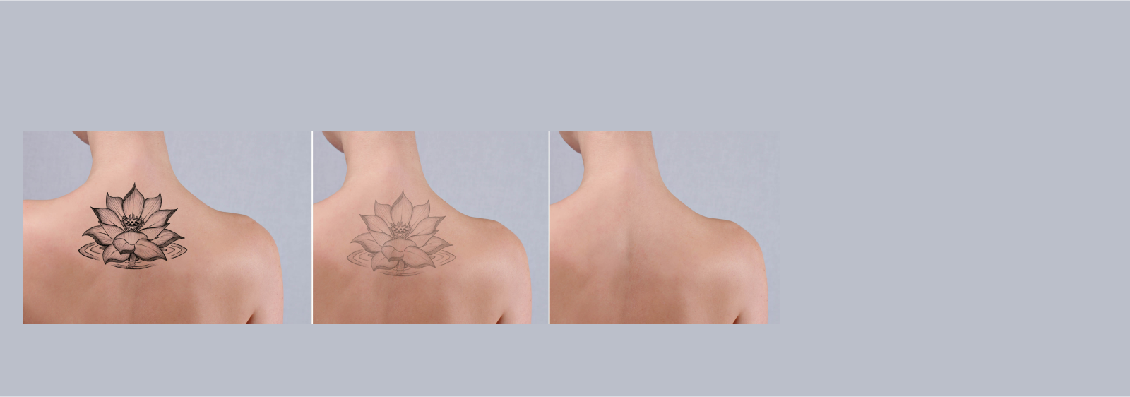 tattoo removal in anna nagar